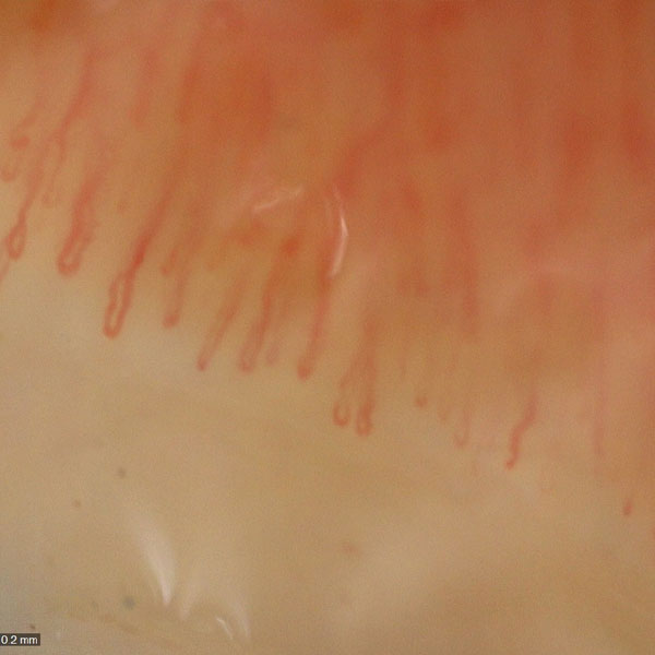 COXARTROSIS